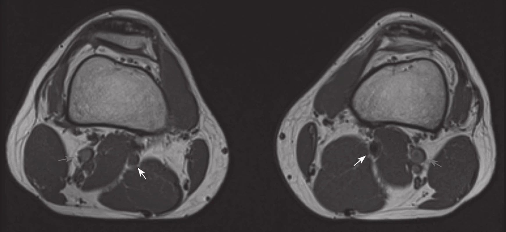Pacient 1
Magnetická rezonance prokazující oboustranný entrapment syndrom arteria poplitea II. typu; šedá šipka – popliteální véna, bílá šipka – popliteální tepna.
Fig. 1: Patient 1
Magnetic resonance imaging demonstrating bilateral popliteal artery entrapment syndrome type II; grey arrow – popliteal vein, white arrow – popliteal artery.