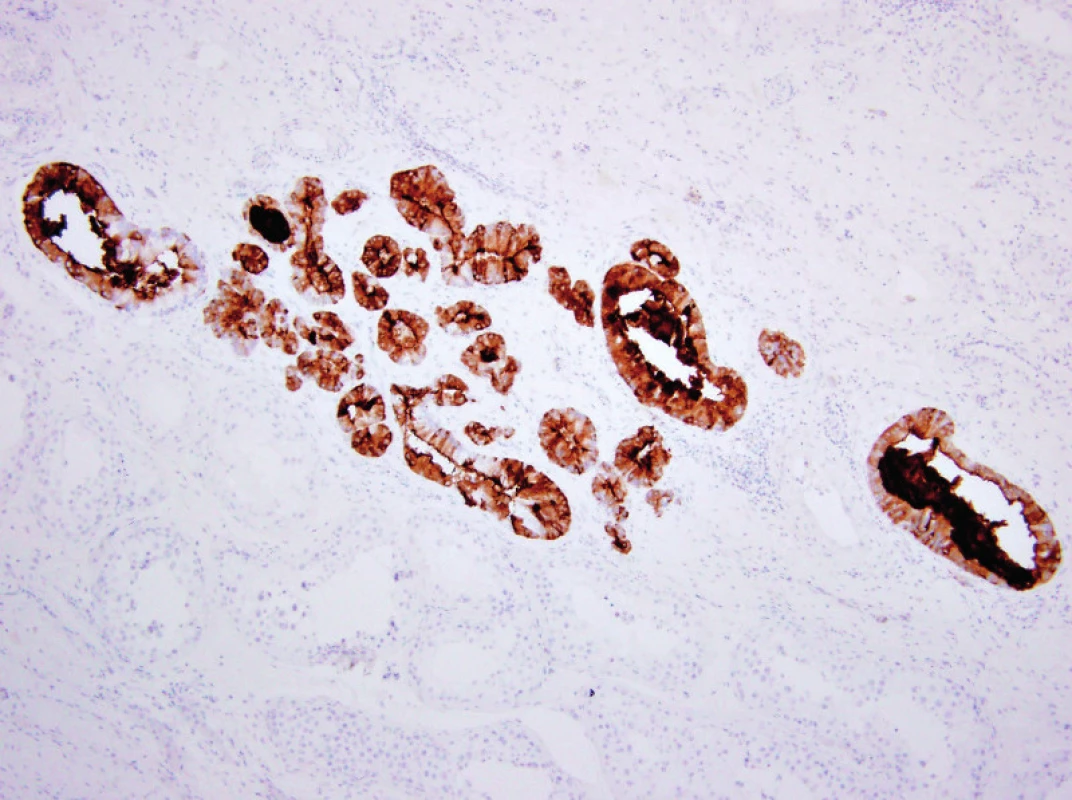 Histologický nález: pozitivita úseků metastázy hůře diferencovaného invazivního adenokarcinomu prostaty v imunohistochemickém průkazu PSMA ve tkáni varlete (původní zvětšení 100krát)