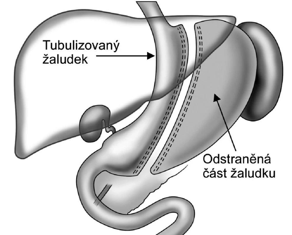 Tubulizace žaludku – sleeve gastrectomy
Fig. 1. Gastric tubulization – sleeve gastrectomy