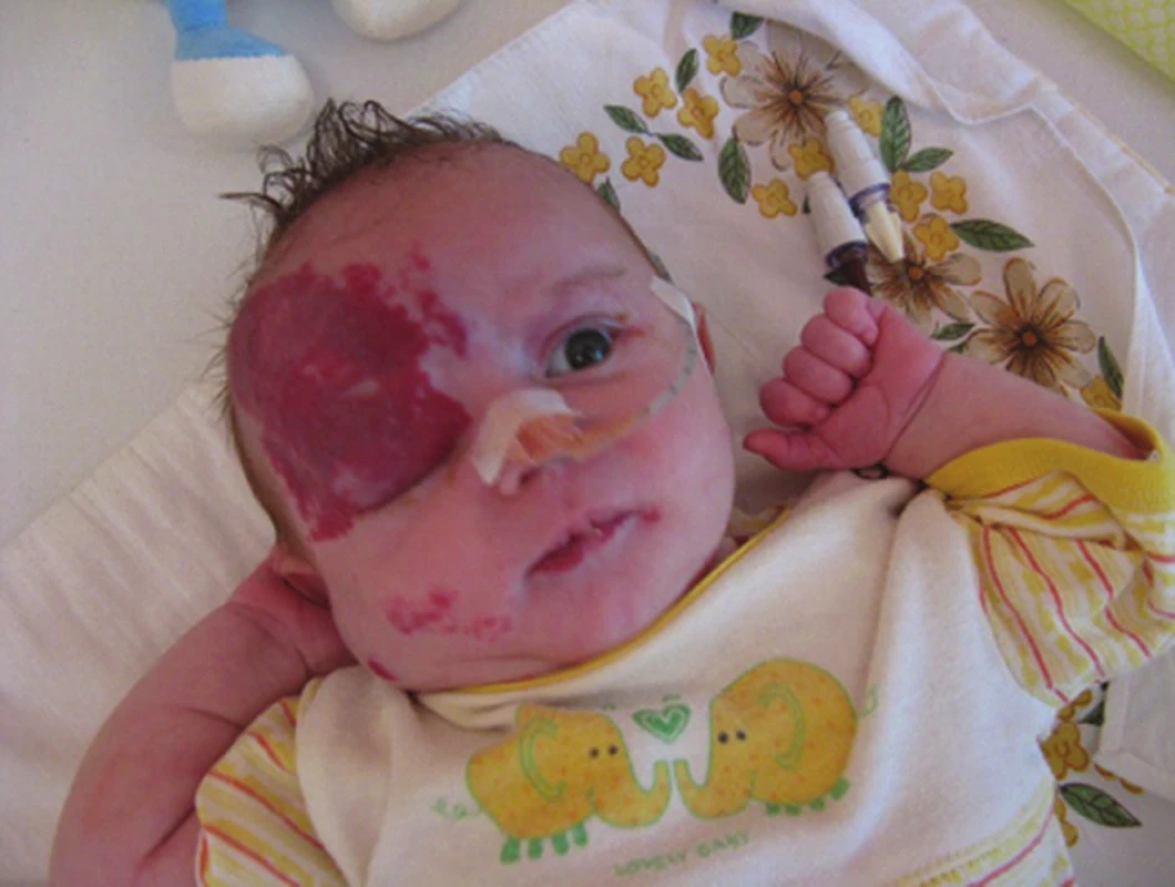 PHACE syndrom