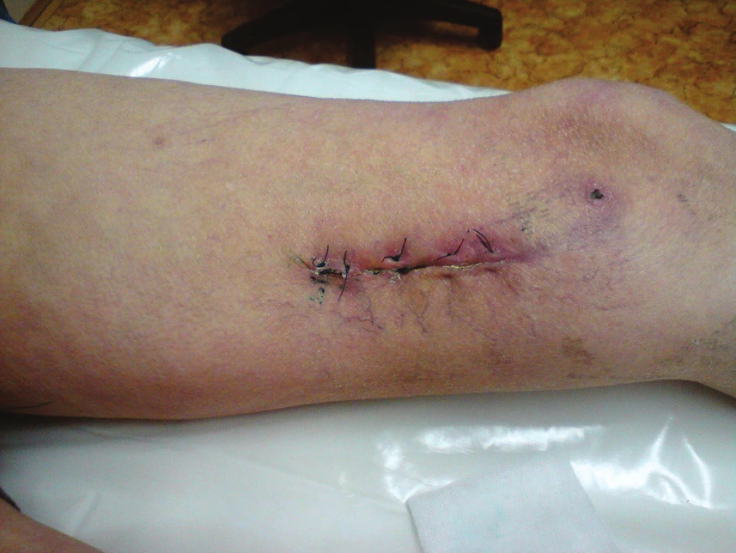 Stav končetiny při propuštění
Fig. 9: Condition of the limb at discharge