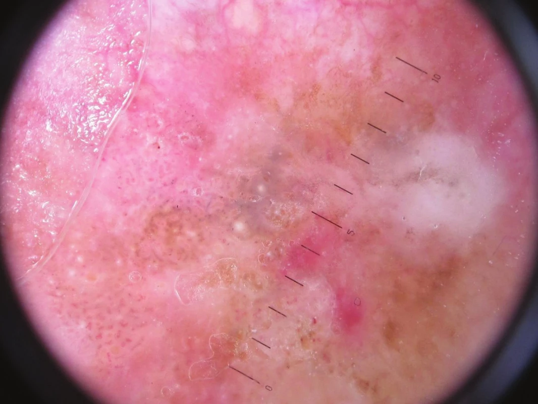 Dermatoskopický nález – keratinové pseudocysty, pseudofolikulární ústí, vlásenkové cévy
Nález svědčí pro seboroickou veruku, bělavé plochy pro její regresi, sytě červené plošky mohou znamenat počínající AFX.