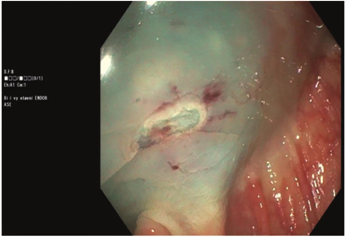 Spodina po odstranění polypu velikosti 10 mm
Fig. 2: Base of the polyp sized 10 mm after polypectomy