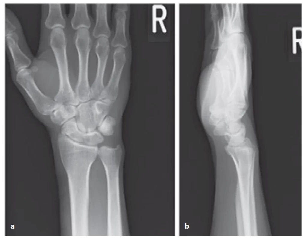 Preoperative X-rays of the wrist. a) Anteroposterior view; b) lateral view.