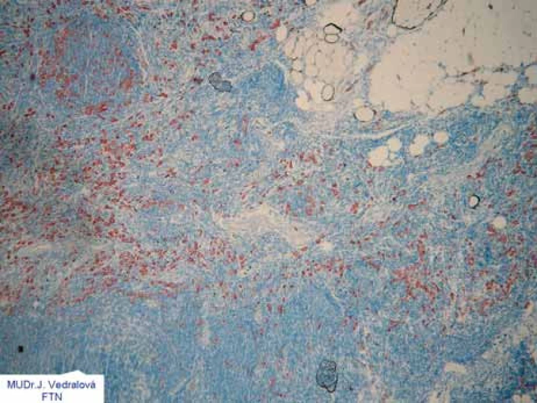 Imunocytochemickým vyšetřením lze spolehlivě identifikovat i jednotlivé nádorové buňky (červené).