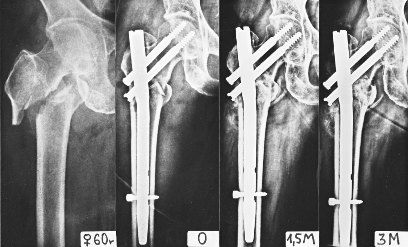 Vliv úhlu hřebu na osteosyntézu intertrochanterické zlomeniny: a – intertrochanterická třífragmentová zlomenina s krátkou laterální kortikalis proximálního fragmentu; b – osteosyntéza provedena PFN 135°, distální skluzný šroub prochází lomnou linií a brání úplné kompresi úlomků v ose dříku hřebu, a to navzdory distálnímu zajištění; c – 6 týdnů po operaci je postavení zajišťovacího šroubu v dynamickém otvoru stejné; d – 3 měsíce po operaci je zlomenina téměř zhojena, pokud by však byl odlomen malý trochanter s přilehlou kortikalis, hrozilo by zlomení hřebu, proto je lépe použít v těchto případech hřeb s úhlem 130°, kdy skluzné šrouby procházejí laterální kortikalis proximálněji. 
Fig. 12: The relation of the nail angle on internal fixation of an intertrochanteric fracture: a – an intertrochanteric three-fragment fracture with a short lateral cortex of the proximal fragment; b – internal fixation by PFN 135°, the distal lag screw passes through the fracture line and prevents full compression of the fragments along the axis of the nail stem, despite distal locking; c – 6 weeks after operation, the position of the locking screw in the dynamic hole is the same; d – 3 months after operation, the fracture has almost healed, however, where the lesser trochanter is separated together with the adjacent cortex, there would be a danger of breaking of the nail; therefore it is better to use a 130° nail in these cases, when lag screws pass through the lateral cortex more proximally.