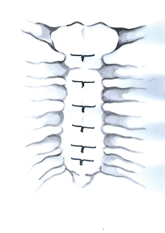 Technika jednotlivých transsternálních drátů (Kresba archiv autora)
Fig. 3: Single transsternal stainless steel wire closure