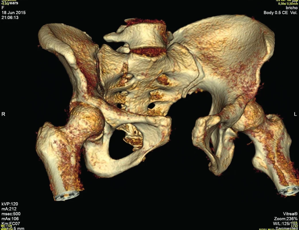 CT vyšetření, 3D model