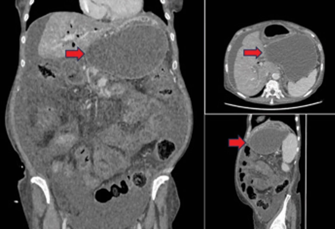 Koronárny, axiálny a sagitálny rez, kolekcia vyznačená šípkou. Fig. 2. Coronary, axial and sagittal view, collection marked by arrow. 