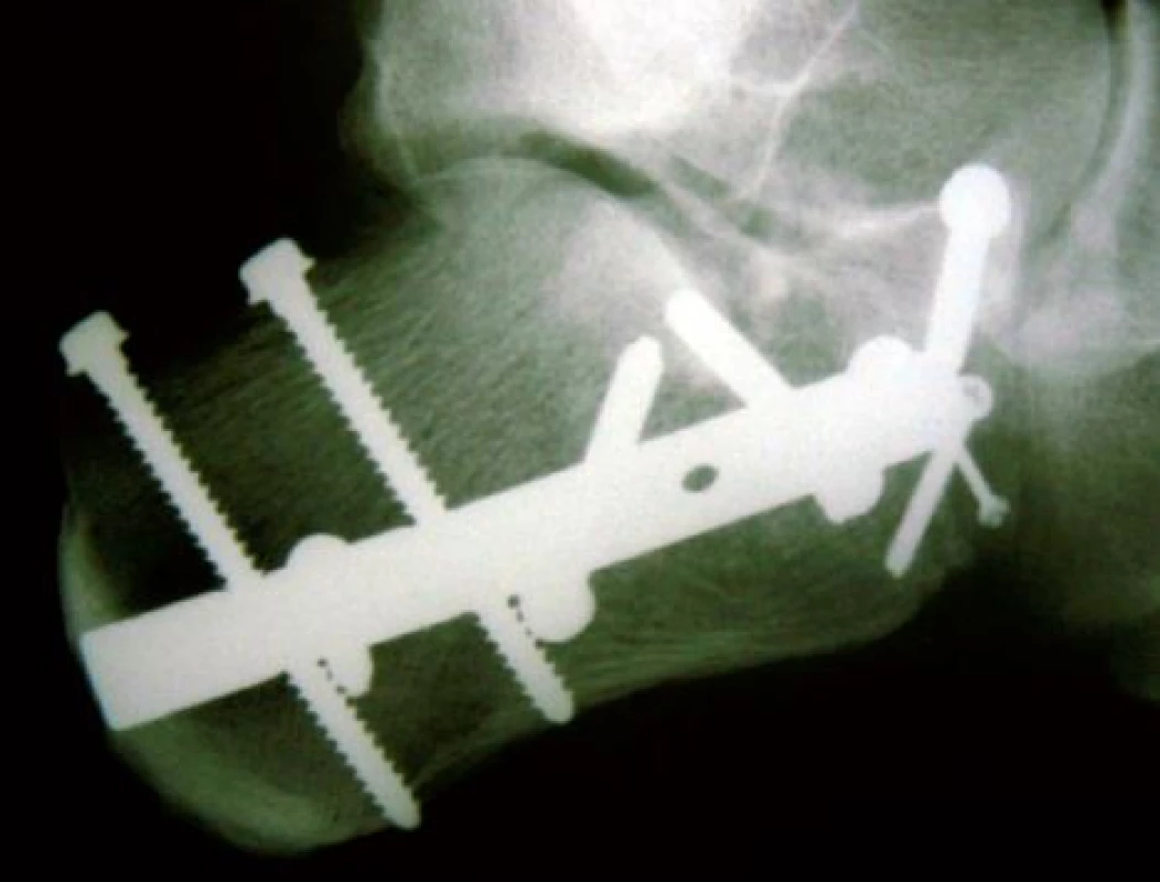 C-NAIL doplněn fixací processus anterior samostatnými šrouby 3,5 mm, 2,0 mm a 1,5 mm
