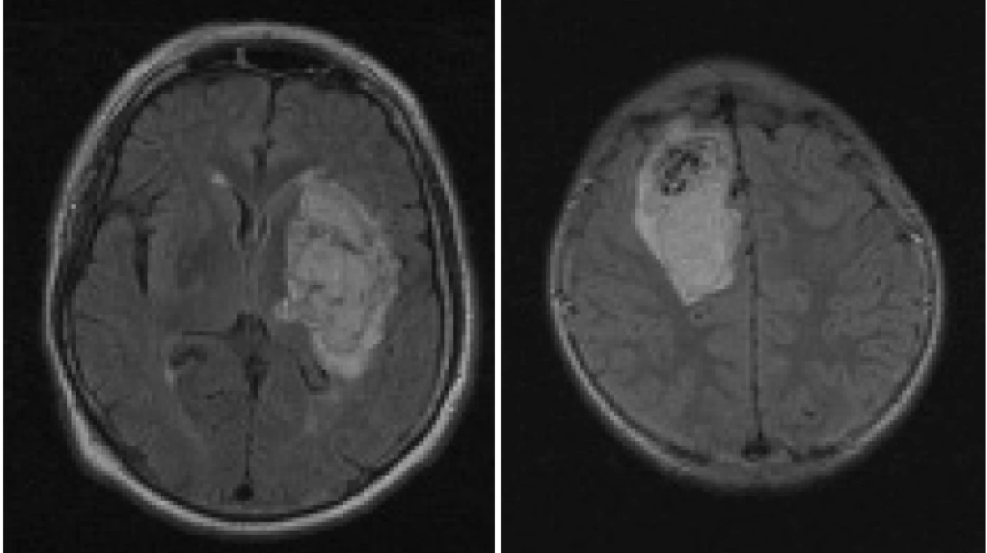 FLAIR sekvence. A: Ložisko akutní hypertonické intracerebrální hemoragie v oblasti levostranných bazálních ganglií a capsula interna. B: Arteriovenózní malformaci uložená v pravém frontálním laloku s ložiskem akutní intracerebrální hemoragie; pacient přijat pro 1 hodinu a 45 minut trvající těžkou levostrannou centrální hemiparézu.