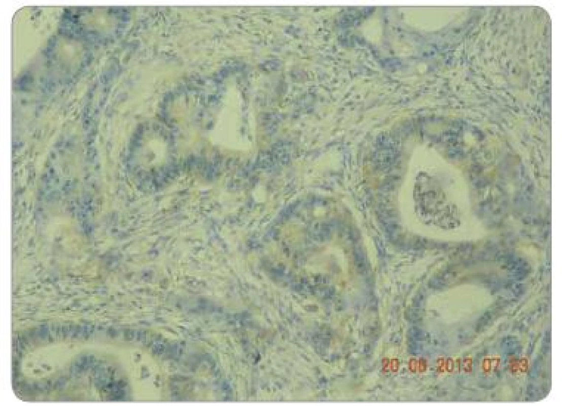 Hodnocení intenzity exprese EGFR pomocí IHC: EGFR 1+, zvětšení 200×.