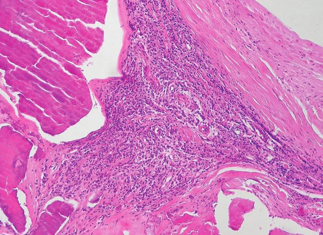 Chronic inflammatory infiltrate (H&amp;E stain)