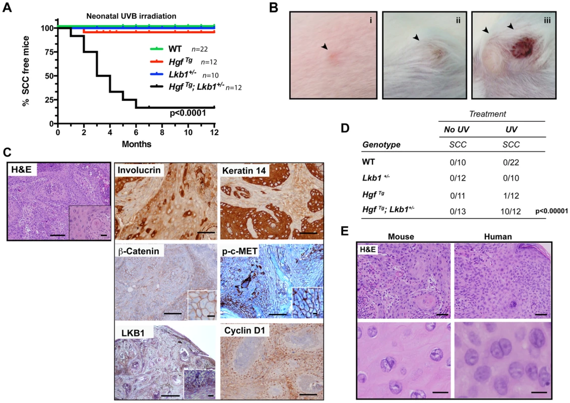 <i>Hgf<sup>Tg</sup>; Lkb1<sup>+/−</sup></i> mice are highly prone to neonatal UVB-induced SCCs.