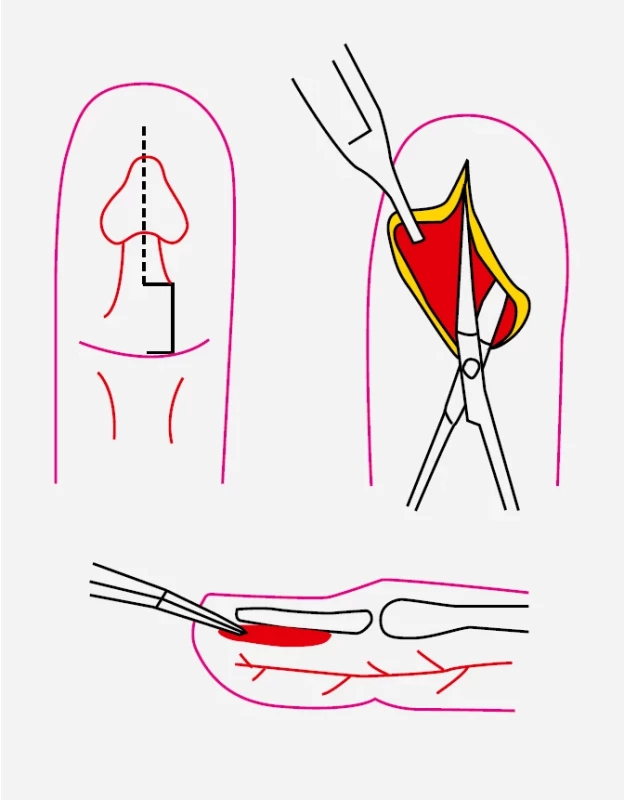 Panaritium – incize na konečném článku s širokým otevřením.
