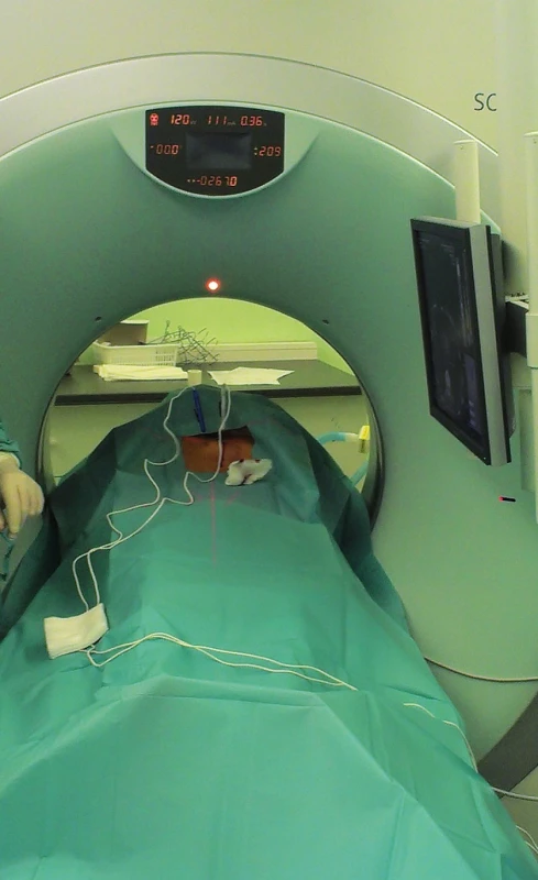 Perkutánní CT navigovaná IRE ablace
Fig. 4. Percutaneous CT guided IRE ablation