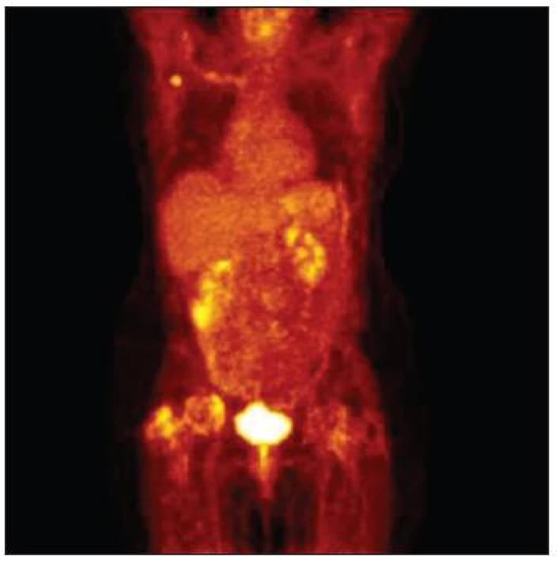 PET/CT – metabolicky aktivní uzlina v pravé axile
Fig. 12. PET/CT – metabolic active lymph node in the right axilla