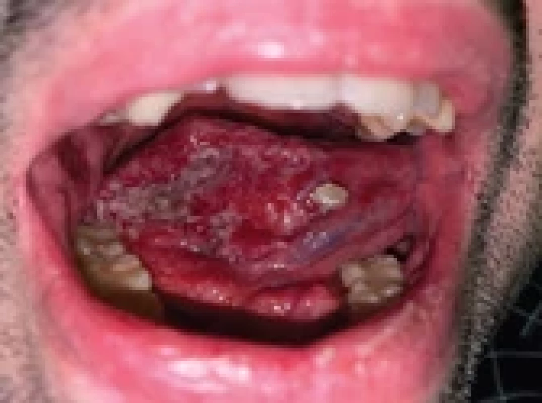 Epidermoid carcinoma right body of the tongue and fl oor of the mouth.