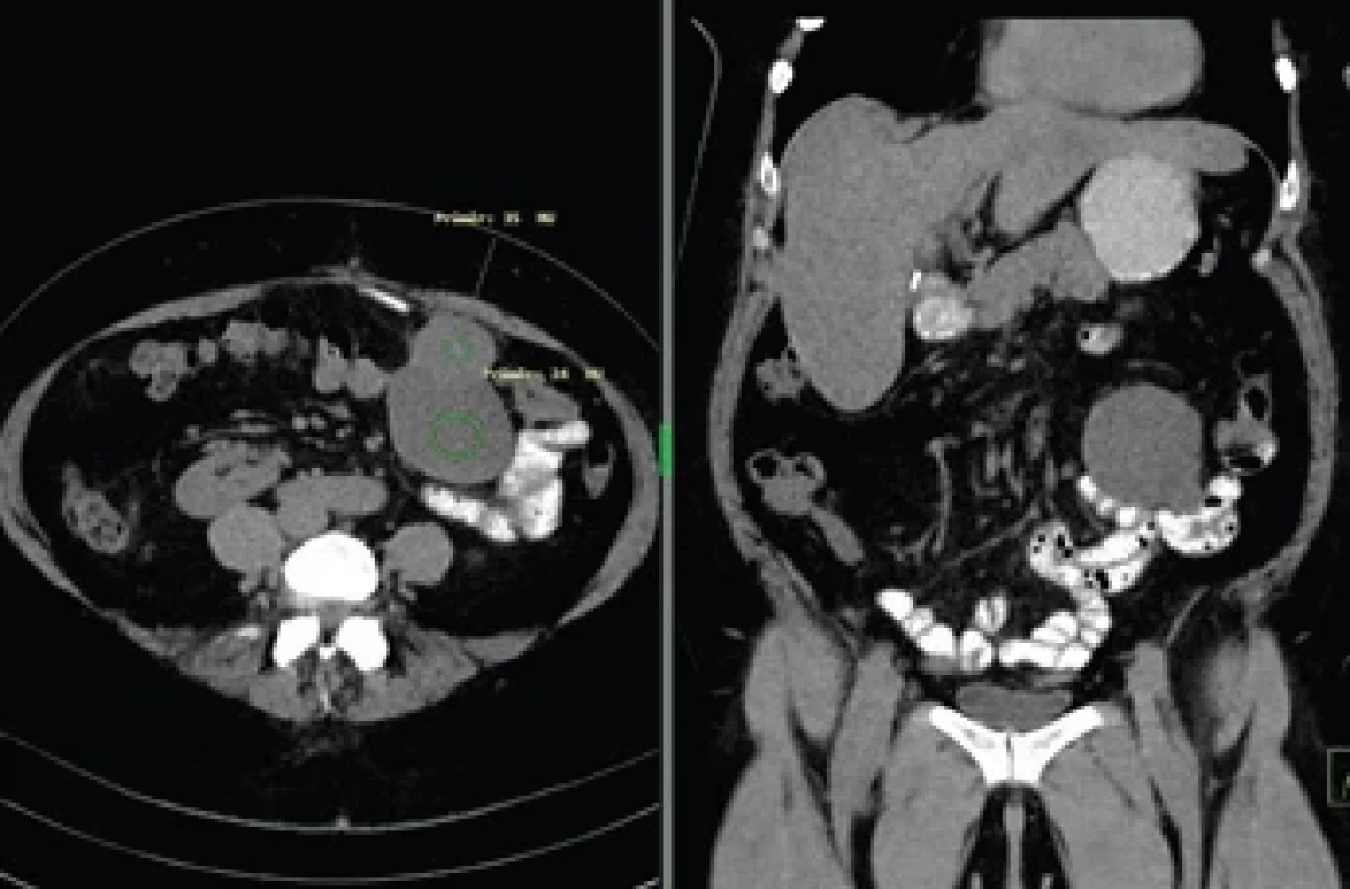 CT snímek tumoru. Fig. 3. CT scan of the tumour.