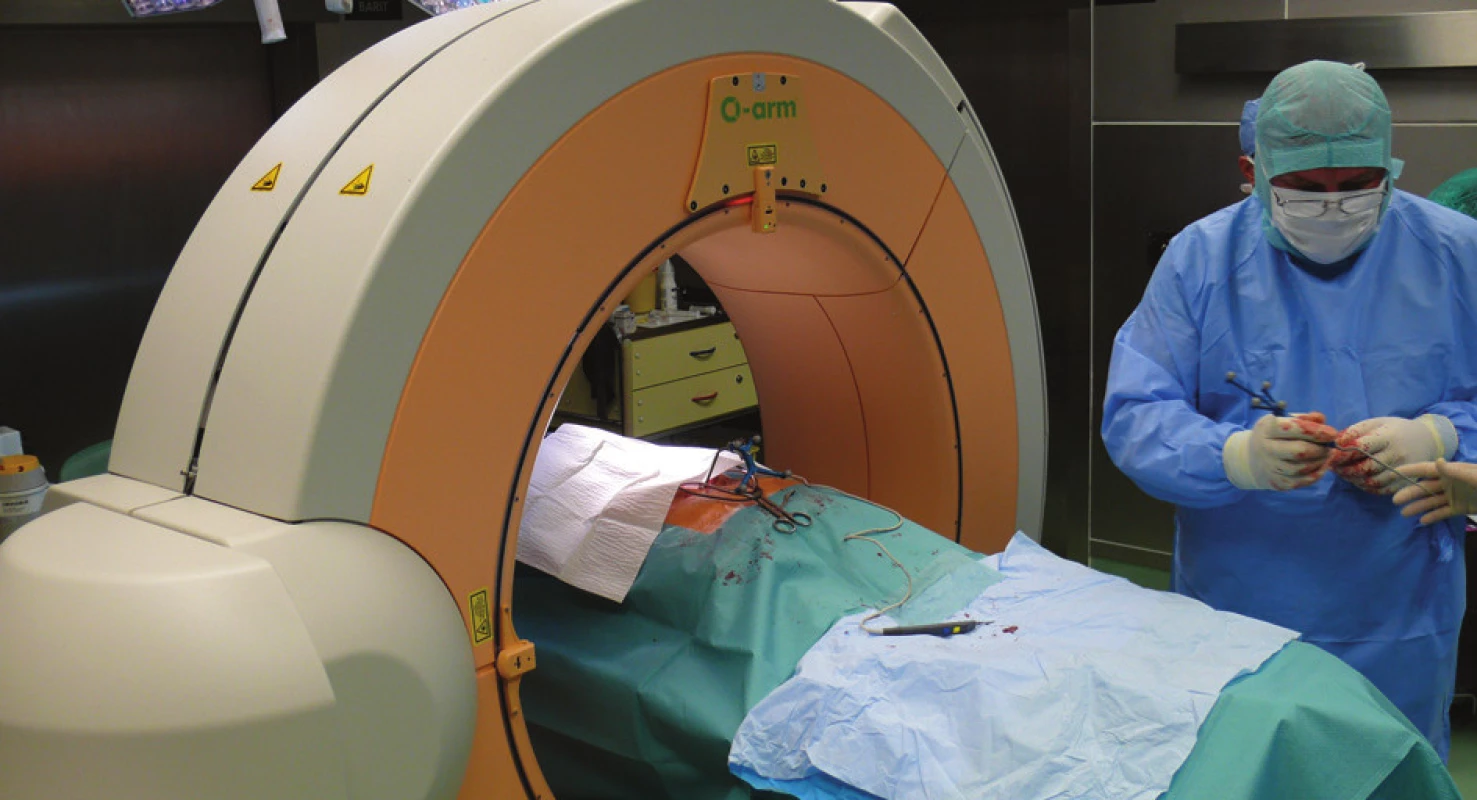Umístění O-ramena při peroperačním CT vyšetření a identifikace speciálních operačních nástrojů navigační stanicí před odsunutím O-ramena mimo operační stůl
Fig. 1: Position of the O-arm during intraoperative CT and identification of special instruments by the navigation station