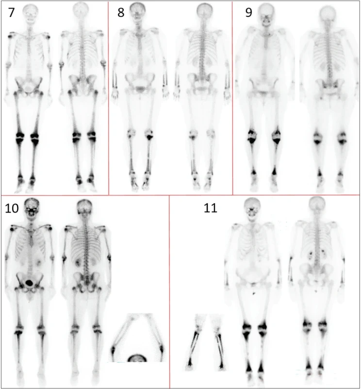 Scintigrafie skeletu – přehled pacientů 7–11, číslování odpovídá tabulce 1.