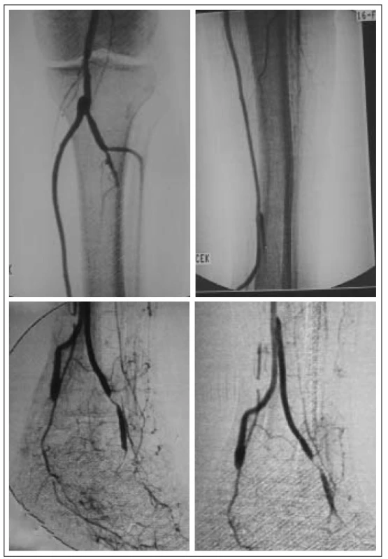 Angiografie – pedální bypass a volný lalok přenesen v druhé době, napojení žilním štěpem.