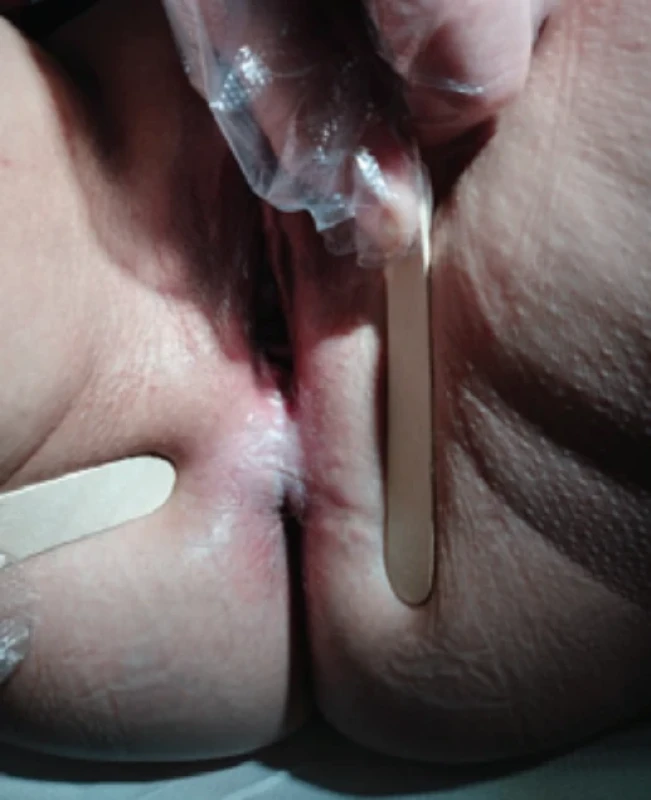 Lichen sclerosus v oblasti perinea. Fig. 4. Lichen sclerosus in the perineal area.