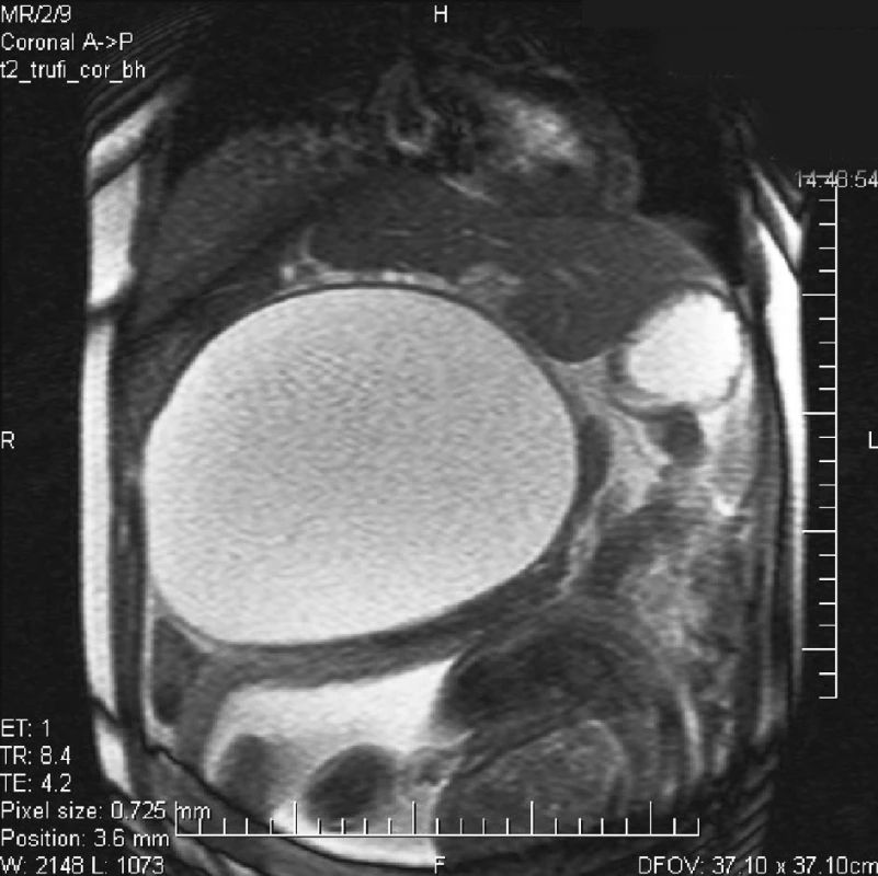 MR nález dutiny brušnej znázorňujúci cystu s kontrastom
Pic. 1. MR intraabdominal finding, depicting a cyst with a contrast
