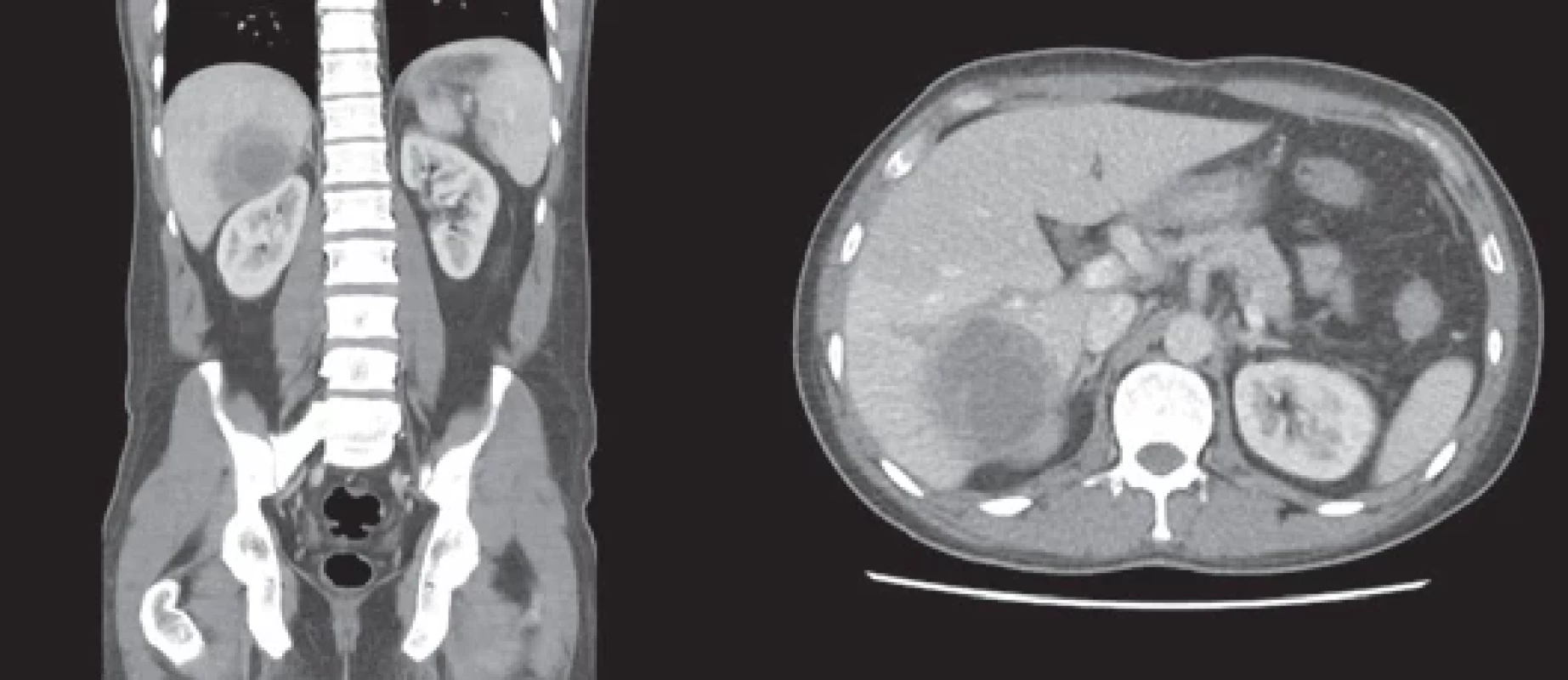 CT břicha v sagitálním a transverzálním řezu s potvrzením abscesového ložiska. (Zdroj: Gastroenterologické oddělení, Nemocnice České Budějovice, a.s.)