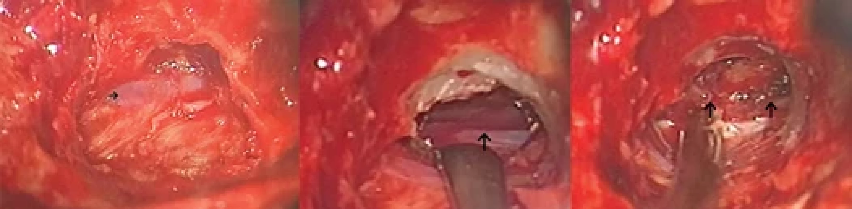 Intraoperační nález likvoro-venózní fi stuly.</br>Fig. 2. Intraoperative fi nding of CSF-venous fi stula.
