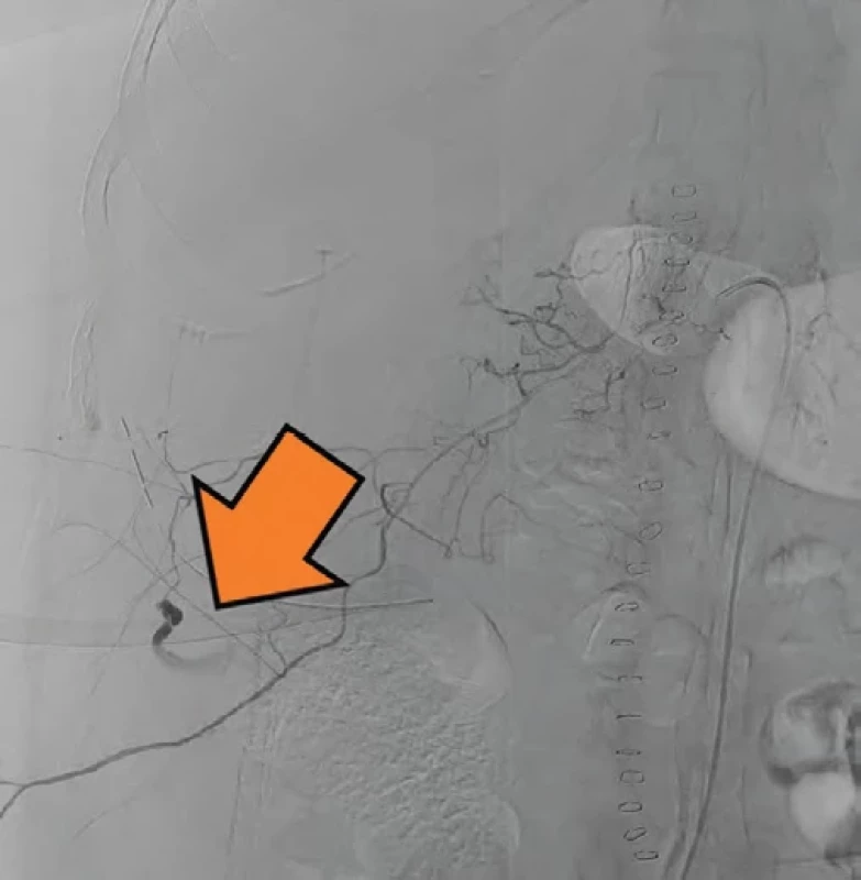 Prokázaný leak z tepny při angiografii. Fig. 4. Proven artery leak on angiography.