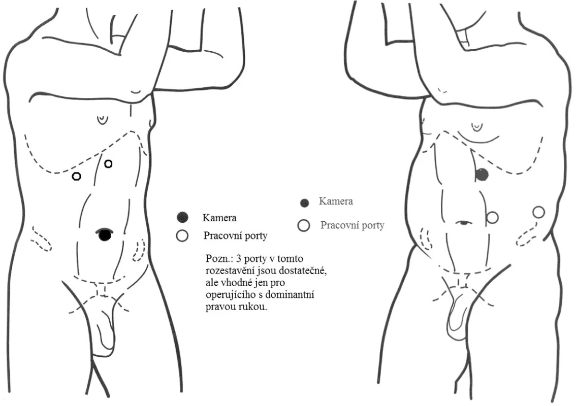 Rozestavení portů u laparoskopické pyeloplastiky
Fig. 1. Placement of ports in laparoscopic pyeloplasty