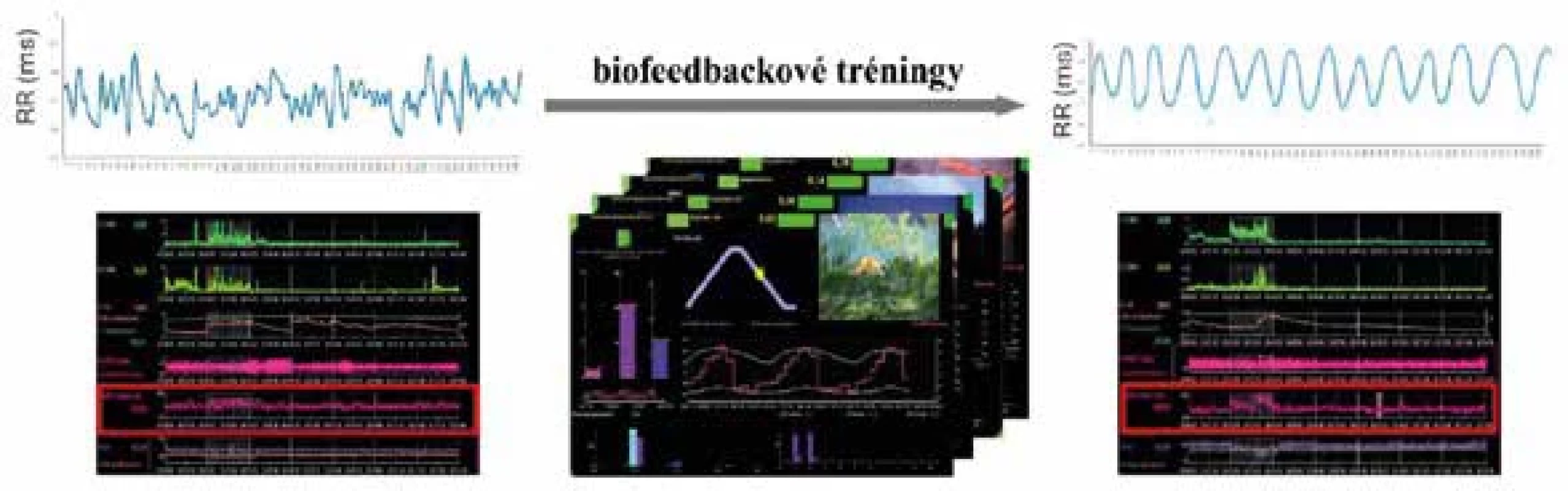 Aplikácia biofeedbackových tréningov u pacientky s obezitou (Ústav fyziológie a Martinské centrum pre biomedicínu, JLF UK). Počas biofeedbackových tréningov pacientka pomocou dychového metronómu a vizualizácie natrénovala regulované abdominálne dýchanie individuálne prispôsobeného optimálneho dychového vzoru (6 dychov/min), čo viedlo ku zvýšeniu VFS v zmysle adaptačných stratégií zvládania stresu.