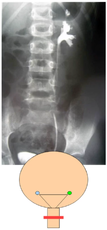 <i>Cystoskopia, sondáž ľavého ústia a retrográdna ureteropyelografia, vľavo ureter fissus dolného segmentu</i>
Fig. 2. <i>Cystoscopy, catheterisation of left ureteric orifice and left retrograde ureteropyelography of ureter fissus of the lower renal segment</i>