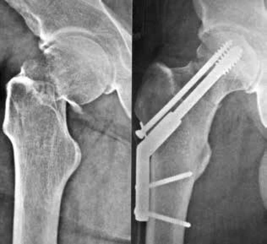 Osteosyntéza intrakapsulární zlomeniny krčku femuru dynamickým skluzným šroubem