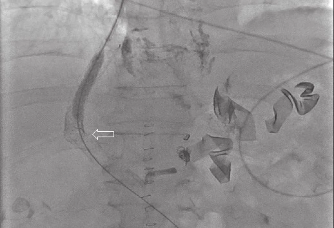 Portografie − balonková dilatece lumen TIPS
Fig. 3: Portography − balloon dilatation of the TIPS lumen