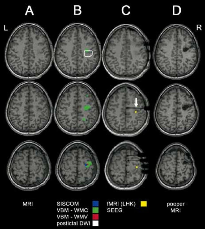 Kombinace pokročilých neurozobrazovacích vyšetření u MR-negativního pacienta.
A) předoperační MR.
B) superpozice výsledků pokročilých zobrazovacích metodik (SISCO M, VBM-WMC – abnormní koncentrace bílé hmoty, VBM-WMV – abnormní objem bílé hmoty, postiktální DWI).
C) MR s intracerebrálními elektrodami (kontakt hluboké elektrody s počátkem iktální EEG aktivity označen šipkou) a výsledek funkční MR s aktivací při motorickém úkolu pro LHK.
D) pooperační MR (pacient 13).