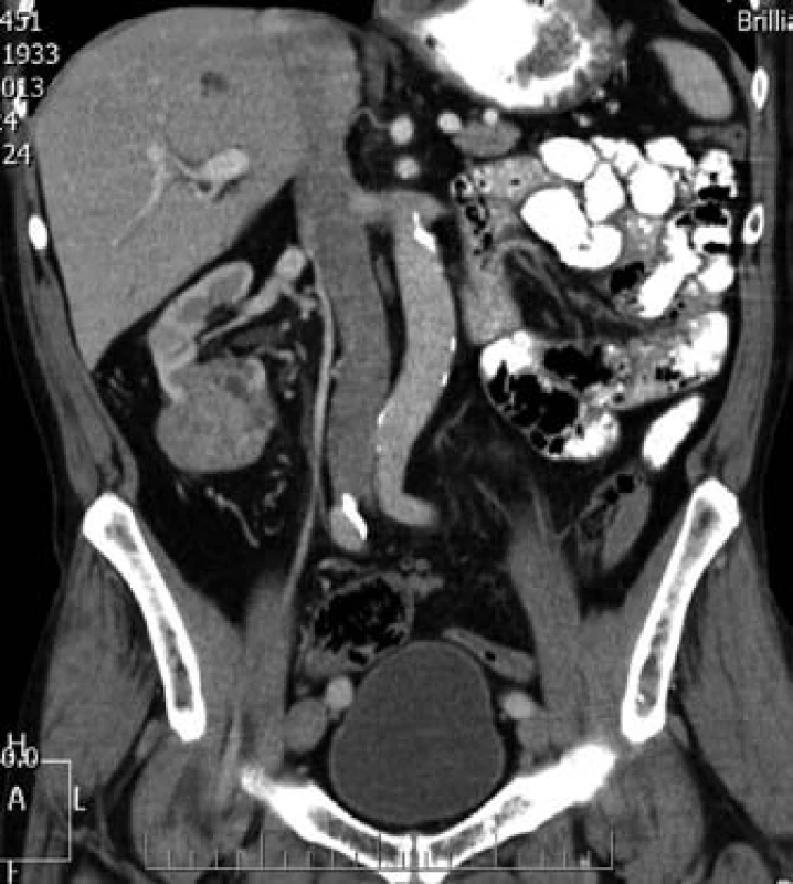 CT – tumor pravé ledviny.
Fig. 3. CT – tumor of the right kidney.