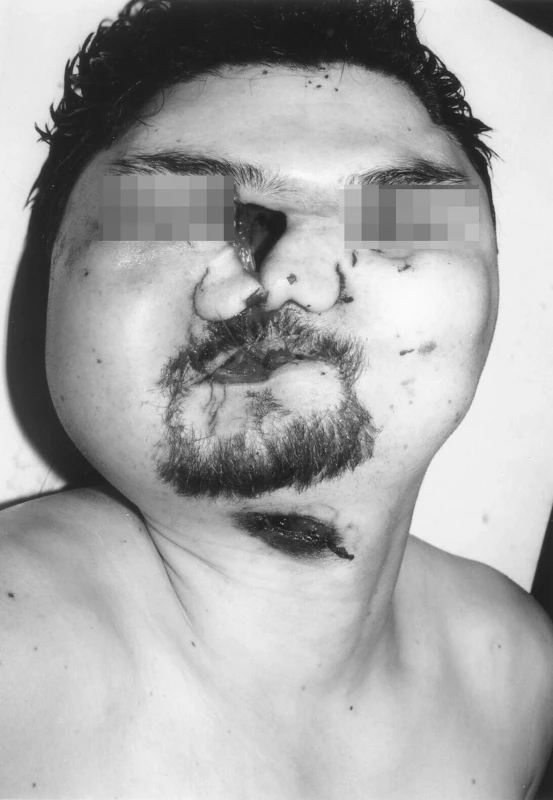 Sebevražda brokovnicí (ráž 16 x 70) – průstřel hlavy při střelbě z absolutní blízkosti. Vstřel pod bradou. V okolí úst, kořene nosu a očních víček četné trhliny měkkých tkání vzniklé vlivem expanze spalných plynů.
