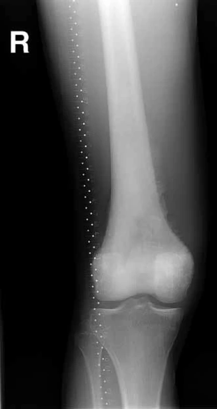 RTG – rozsáhlý osteosarkom distálního femuru, osteoblastická varianta.