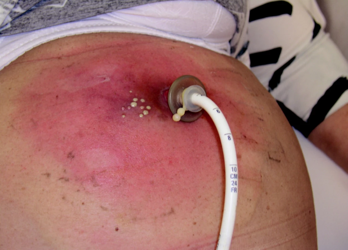 Komplikace PEG – absces