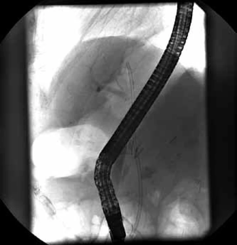 Zavedený 8,5 Fr 12 cm dlhý plastový biliárny stent.
Fig. 4. Inserted 8,5 Fr 12 cm long plastic biliary stent.