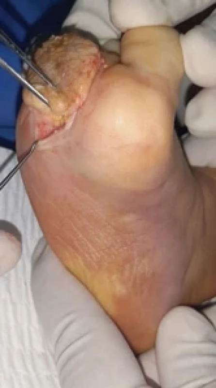 Yellow macroscopic aspect of the tumor.