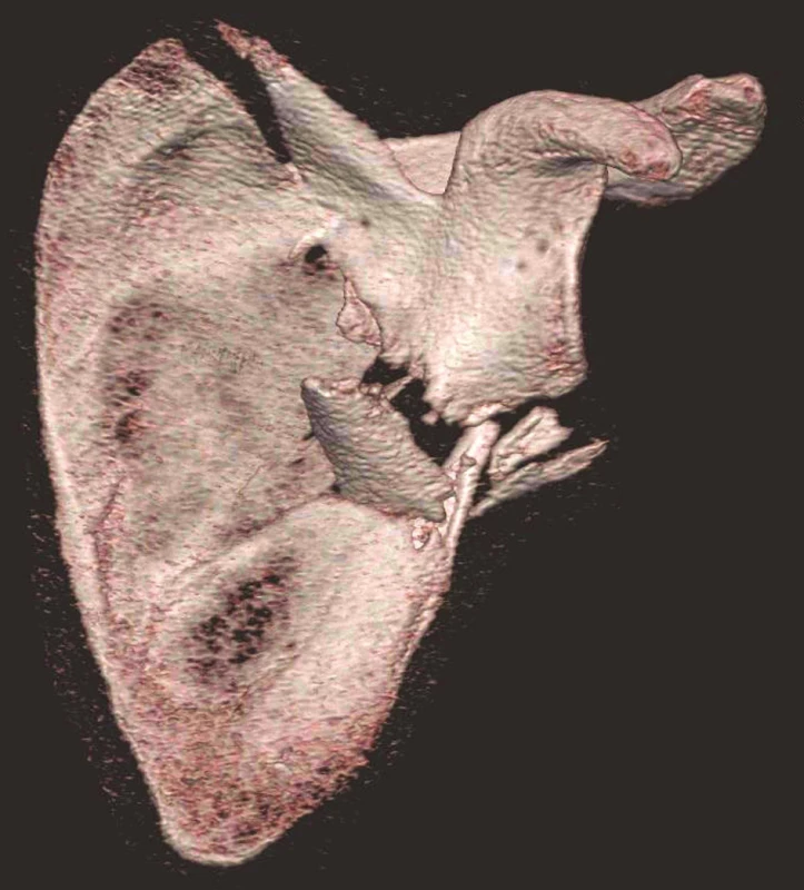Třídimenzionální CT rekonstrukce – pohled z ventrální strany
Fig. 3: Three-dimensional CT reconstruction – anterior view