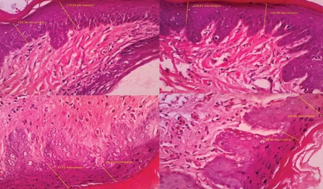 Histology results from gingiva mucous epithelization of rabbit at day 3 after combination of guava leaf ethanol gel (Psidium guajava Linn) and polyvinylpyrrolidone hydrogel.