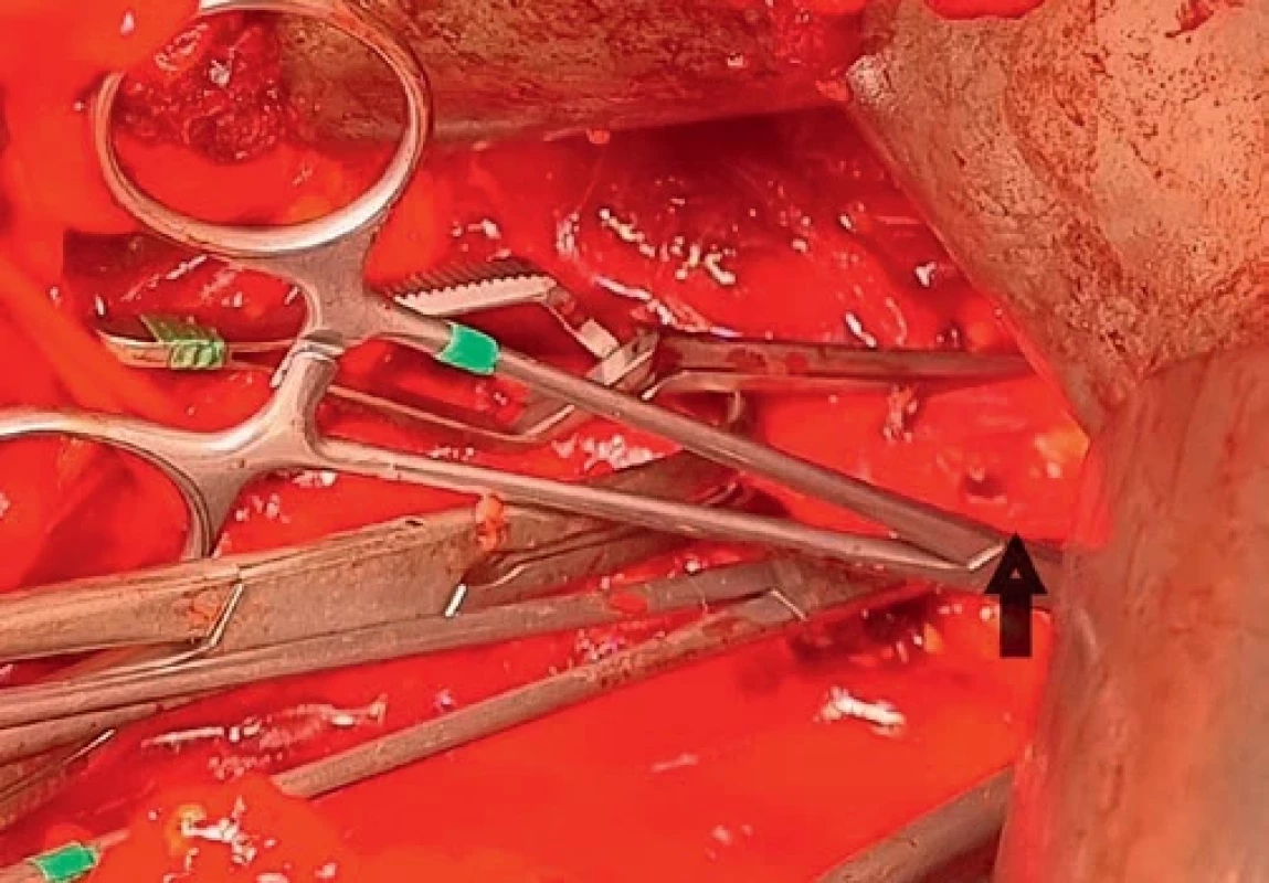 Aortic incision with protruding circular calcification between aortic cross-clamps. Aortotomie s vyčnívající kruhovou kalcifikací mezi aortálními svorkami.