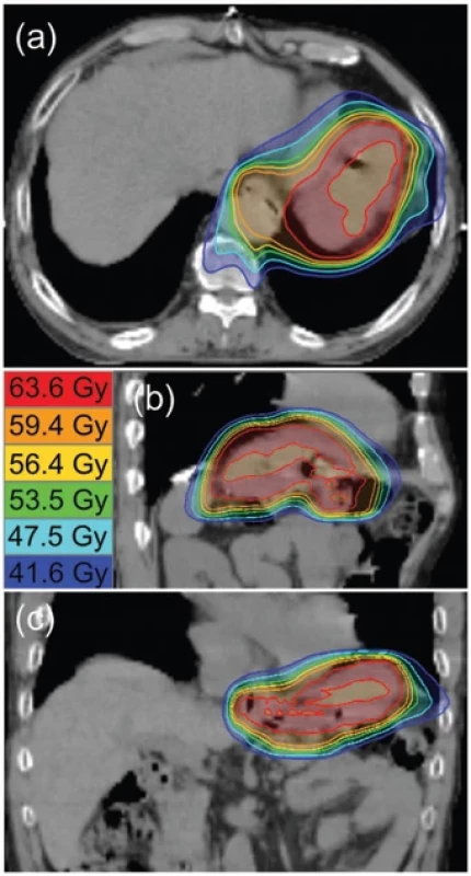 Radiotherapy isodose line distribution.