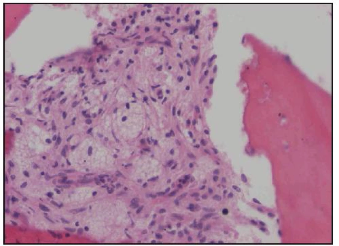 Histologické hodnocení válečku kostní dřeně. Barvení hematoxylin-eozin, zvětšení 200krát. Pěnité histiocyty infiltrují prostory kostní dřeně.