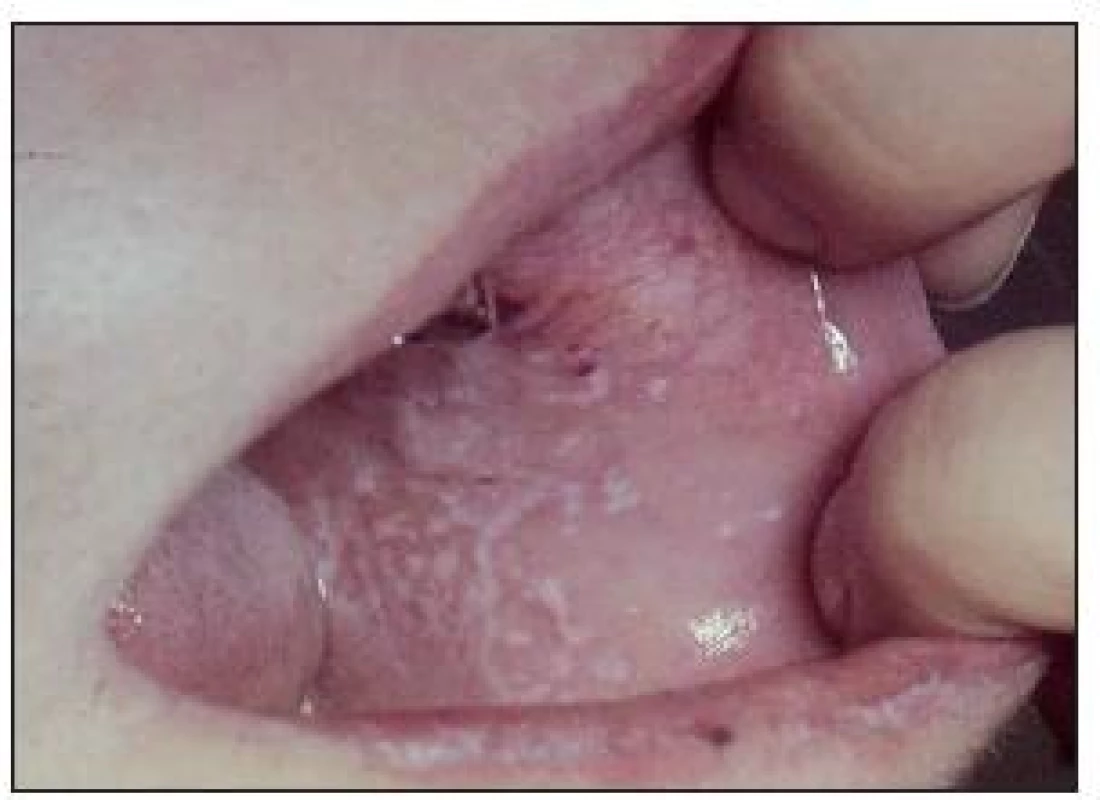 Orální lichen planus (papulózní forma) poměrně často doprovází DM.