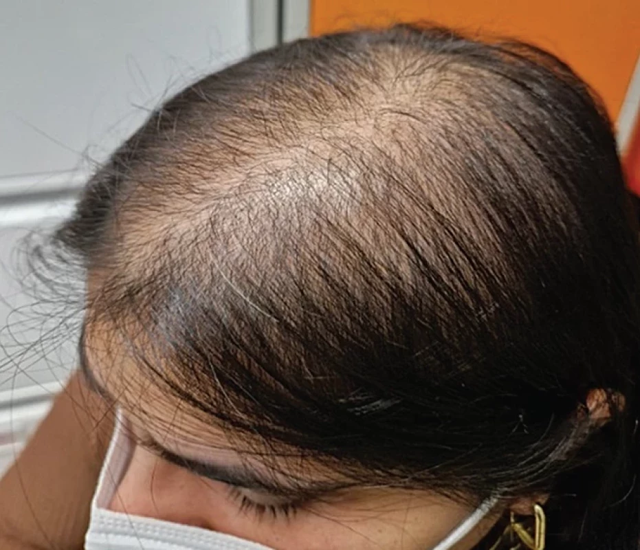 Androgénna alopécia u pacientky s HS (zdroj: archív Kliniky dermatovenerológie UNLP Košice).